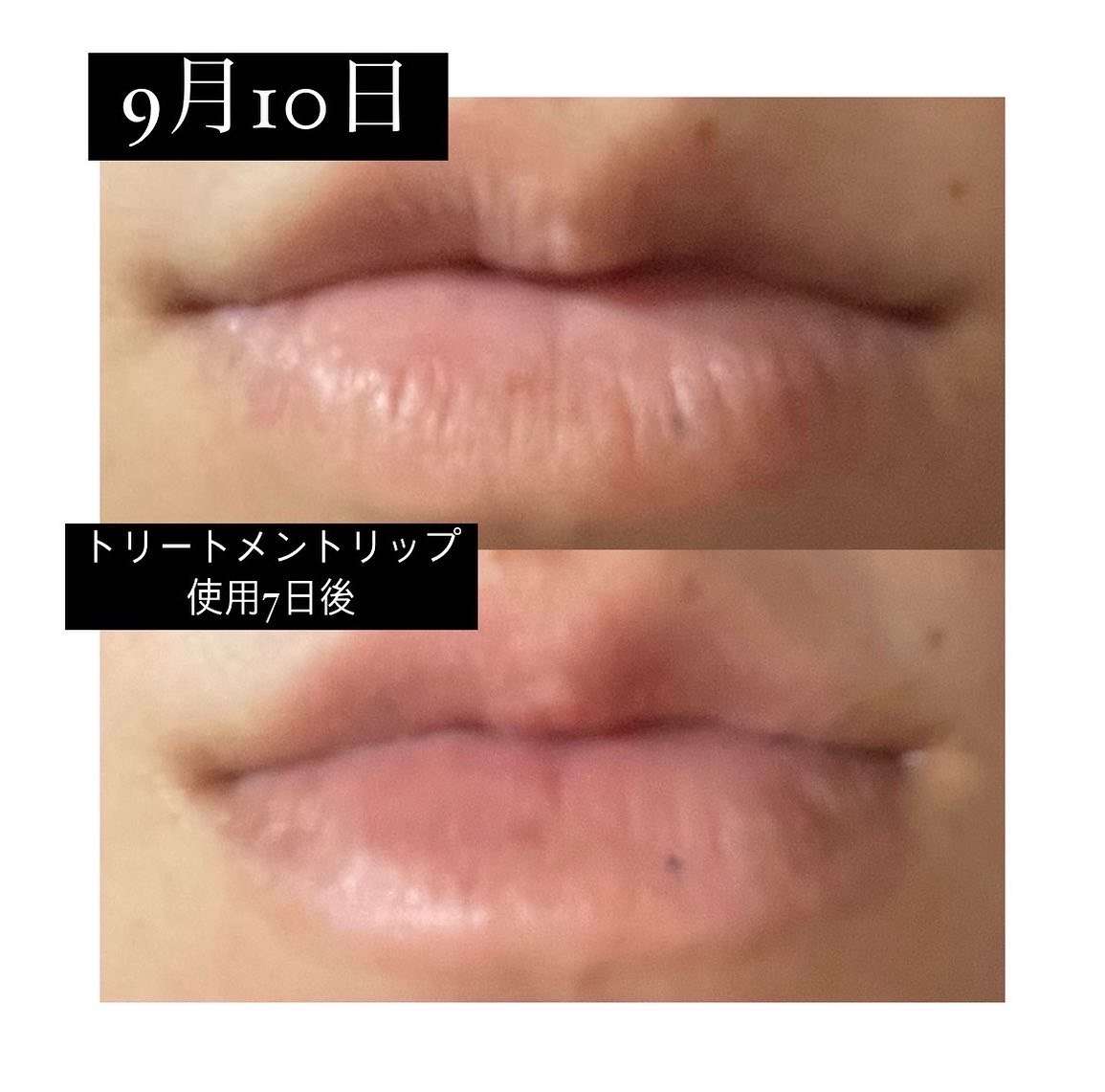 唇の改善｜神戸市東灘区　御影の肌質改善専門salon maru