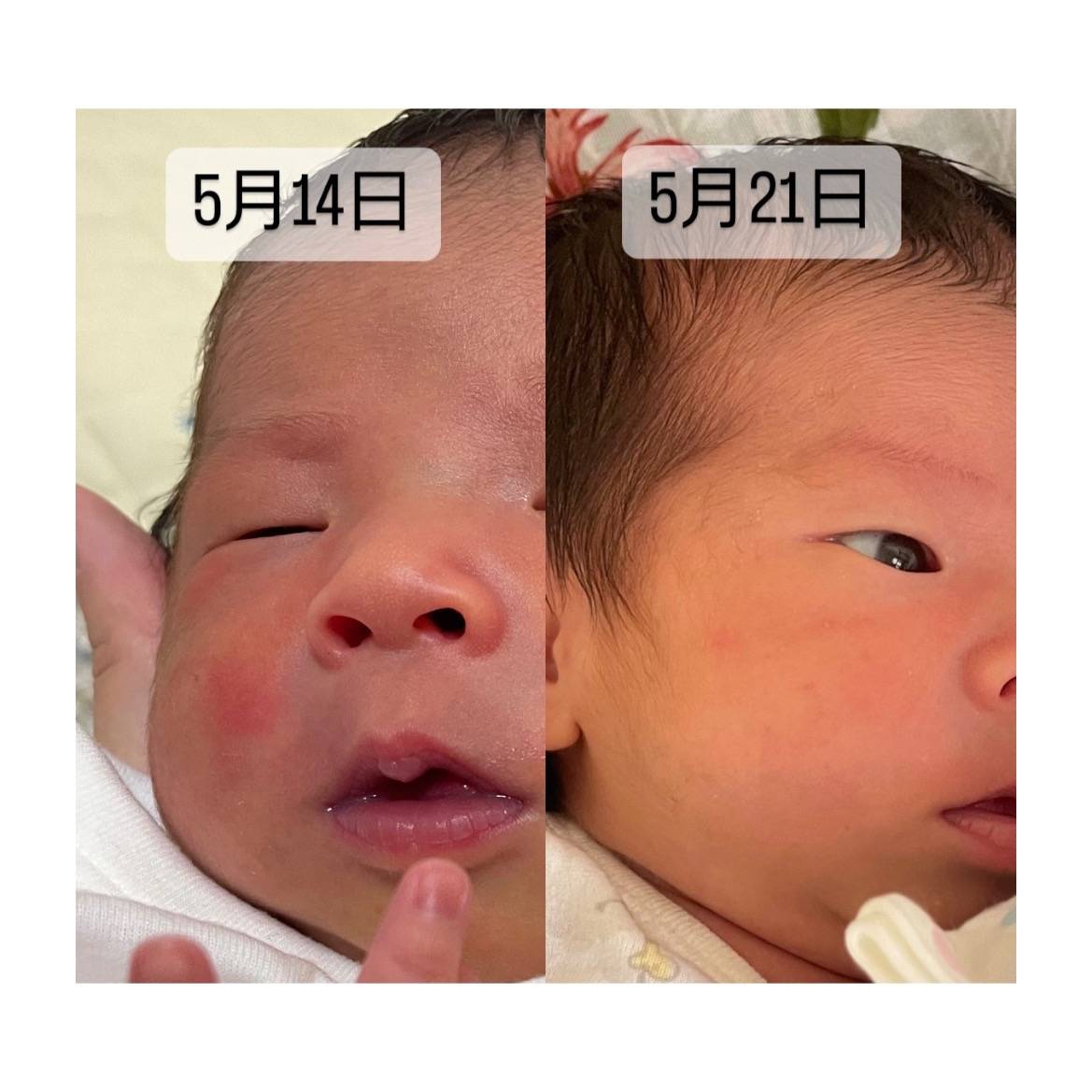 赤ちゃんの改善例｜神戸市東灘区　住吉の肌質改善専門salon maru